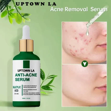 UPTOWN LA Anti Acne serum with Salicylic Acid for oil Control and acne removal 30 ml